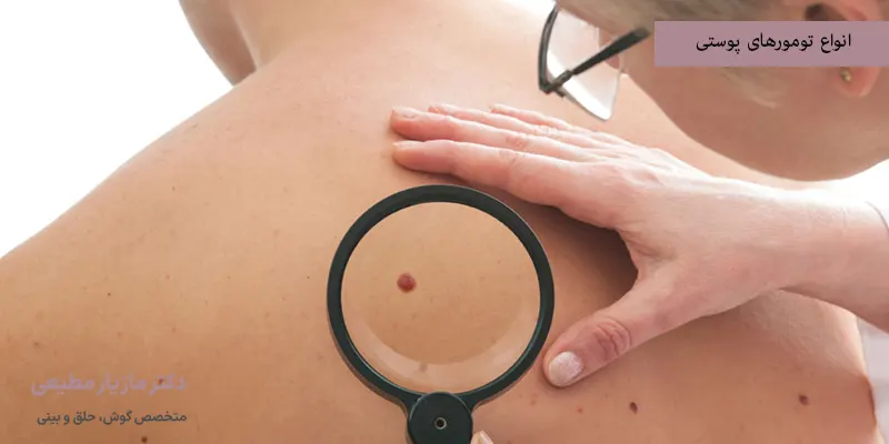 انواع تومورهای پوستی