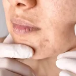 تومورهای پوستی