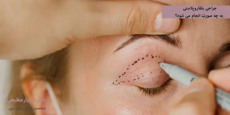 جراحی بلفاروپلاستی به چه صورت انجام می شود؟