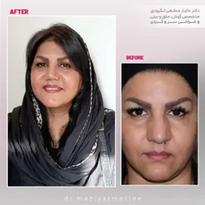 نمونه کار عمل بینی