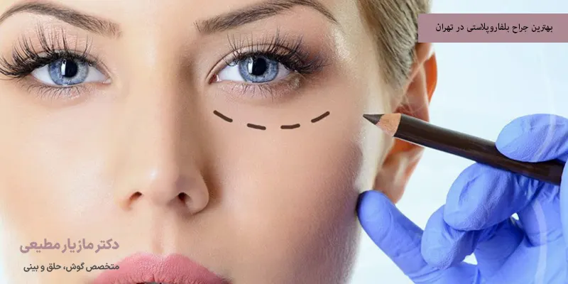 بهترین جراح بلفاروپلاستی در تهران