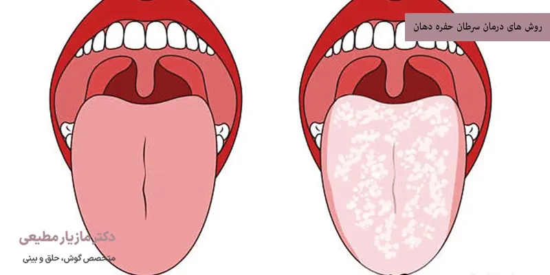 روش های درمان سرطان حفره دهان