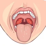 سرطان حفره دهان