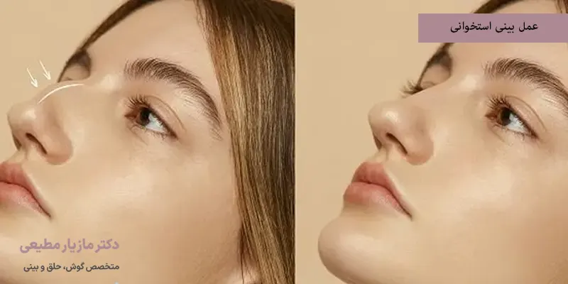 عمل بینی استخوانی