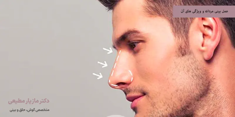 عمل بینی مردانه و ویژگی های آن