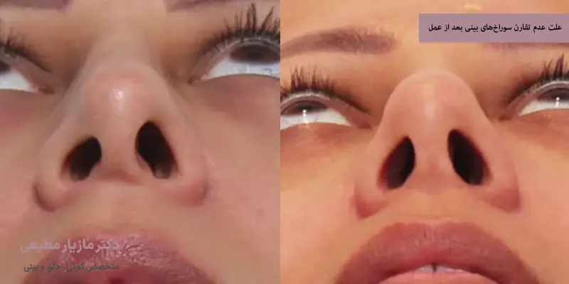 علت عدم تقارن سوراخ‌های بینی بعد از عمل