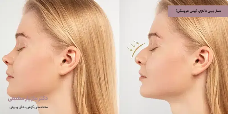 عمل بینی فانتزی (بینی عروسکی)