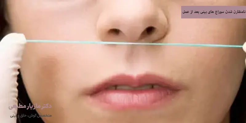 نامتقارن شدن سوراخ های بینی بعد از عمل