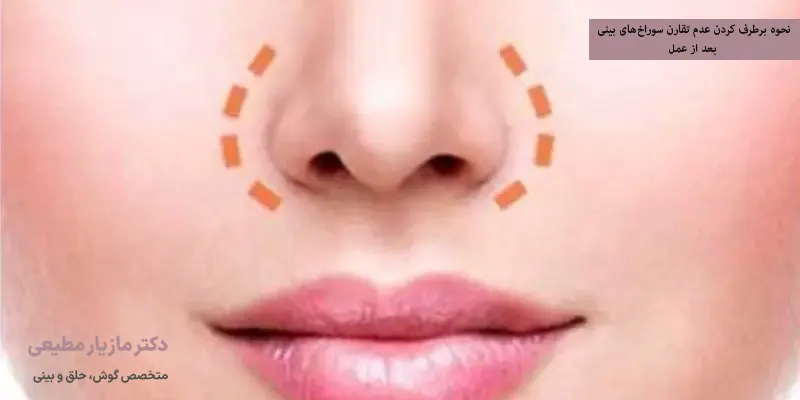 نحوه برطرف کردن عدم تقارن سوراخ‌های بینی بعد از عمل