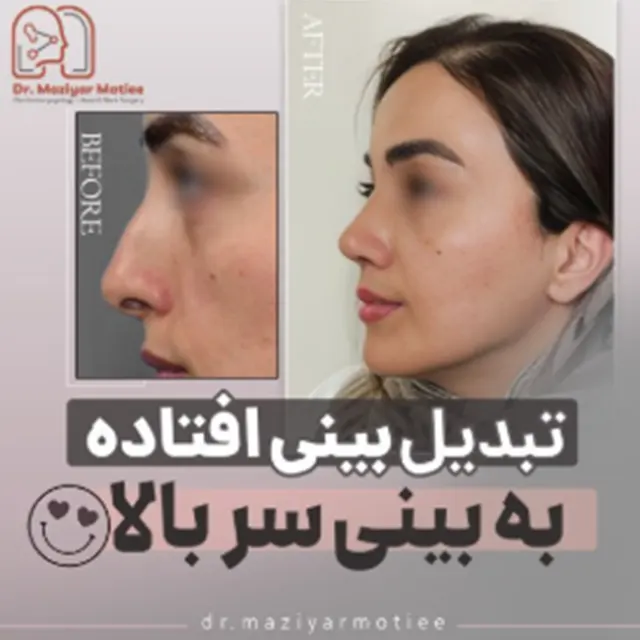 نمونه کار بینی ترمیمی