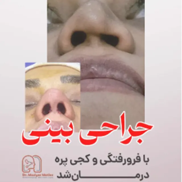 نمونه کار عمل بینی ترمیمی دکتر مطیعی