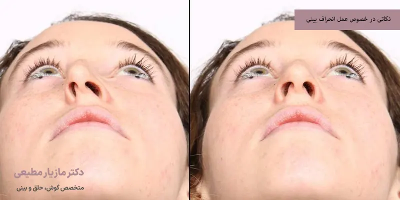 نکاتی در خصوص عمل انحراف بینی