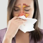 عمل پولیپ بینی