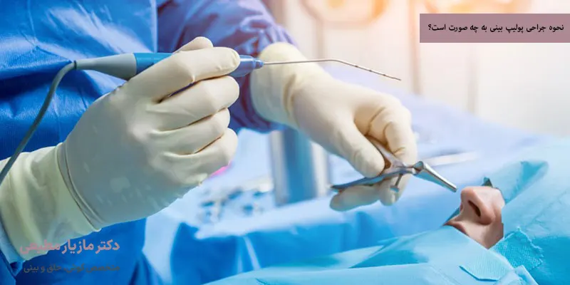 نحوه جراحی پولیپ بینی به چه صورت است؟