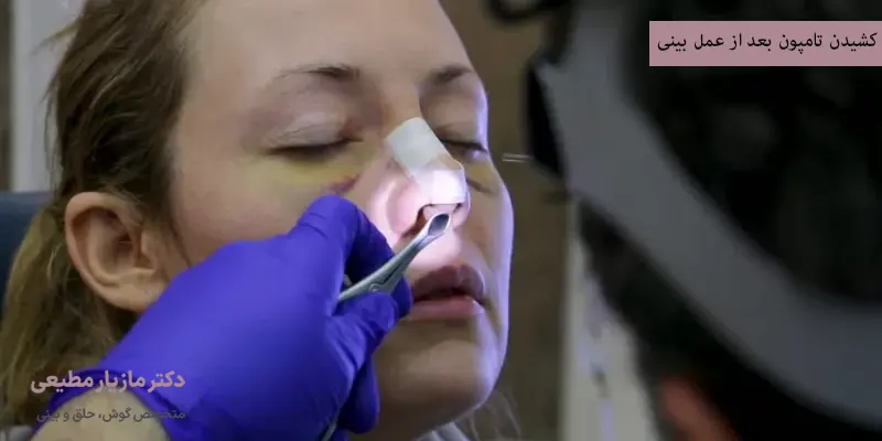 کشیدن تامپون بعد از عمل بینی