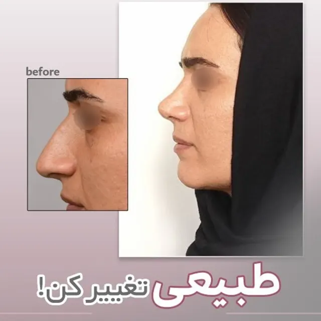 جراحی بینی طبیعی نمونه کار