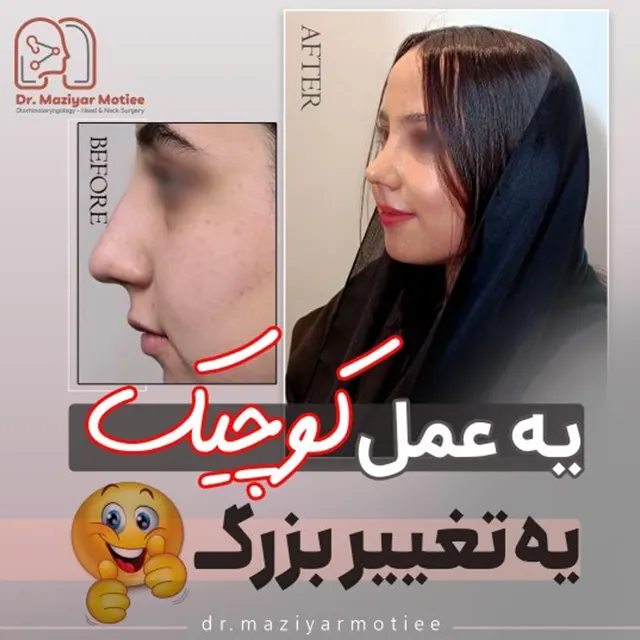 جراحی بینی نمونه کار