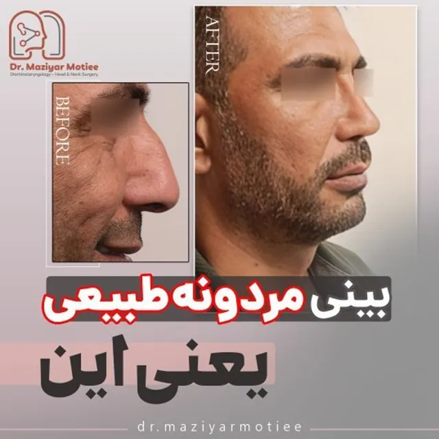 عمل بینی طبیعی مردانه نمونه کار