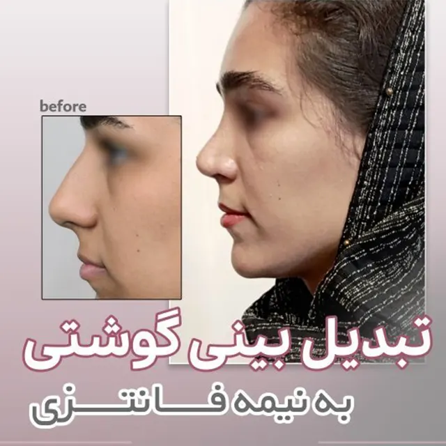 نمونه کار بینی نیمه فانتزی