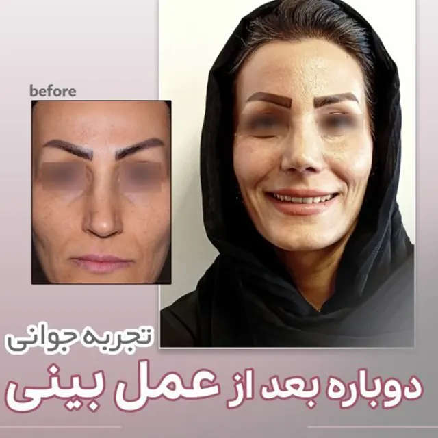 نمونه کار جراحی بینی