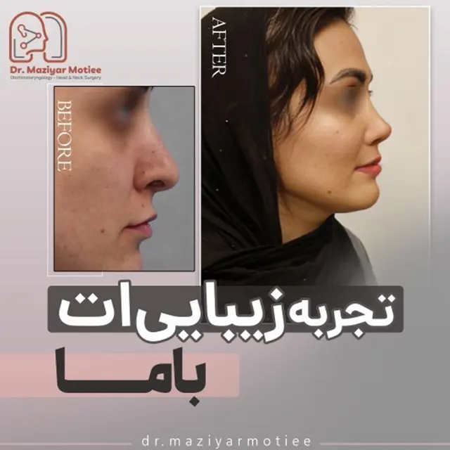 نمونه کار رینوپلاستی