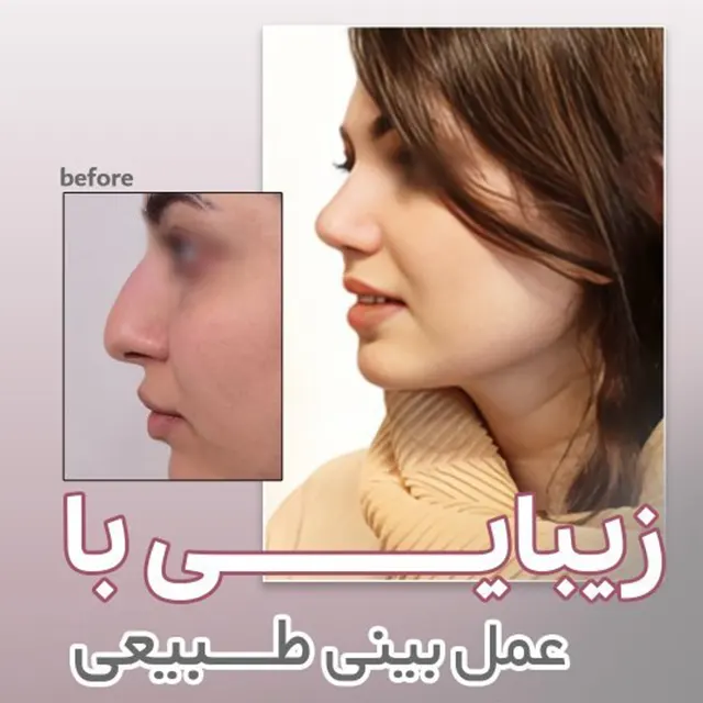 نمونه کار عمل بینی طبیعی