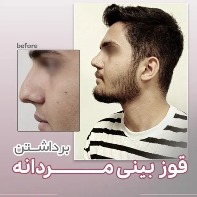 نمونه کار عمل قوزبینی مردانه