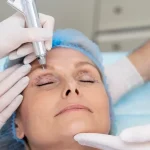 هزینه عمل بلفاروپلاستی