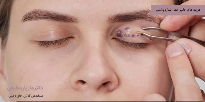 هزینه های جانبی عمل بلفاروپلاستی