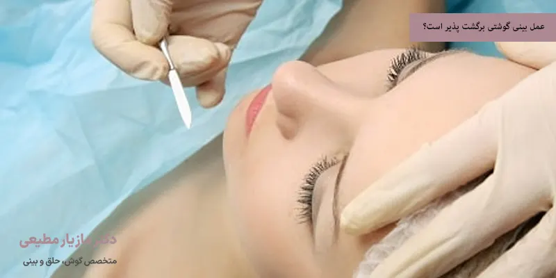 عمل بینی گوشتی برگشت پذیر است؟