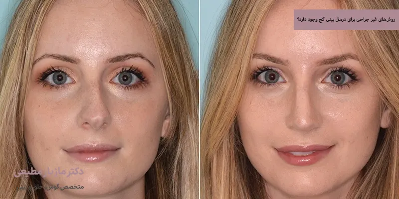 روش‌های غیر جراحی برای درمان بینی کج وجود دارد؟