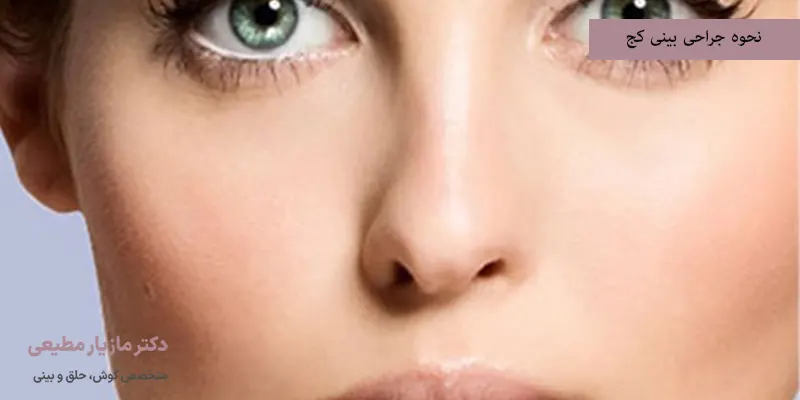 نحوه جراحی بینی کج