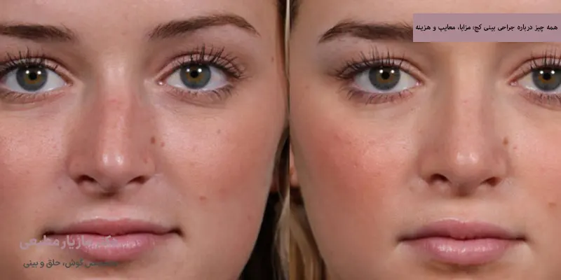 همه چیز درباره جراحی بینی کج مزایا، معایب و هزینه