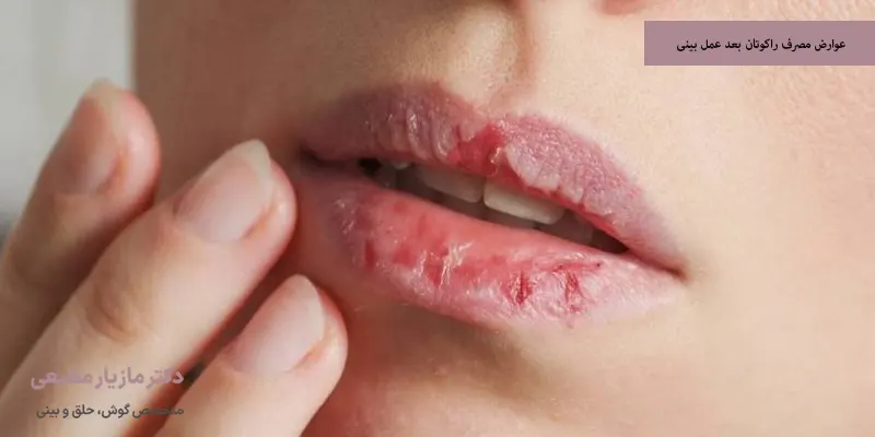 عوارض مصرف راکوتان بعد عمل بینی