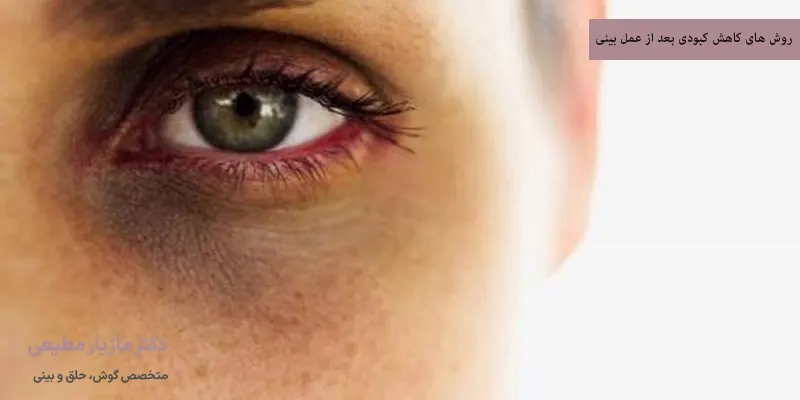 روش های کاهش کبودی بعد از عمل بینی