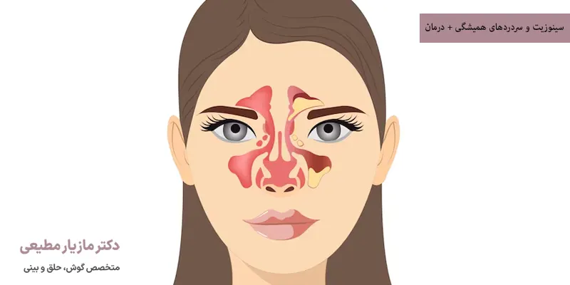 سینوزیت و سردردهای همیشگی + درمان