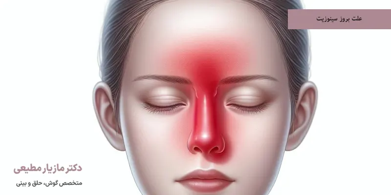 علت بروز سینوزیت