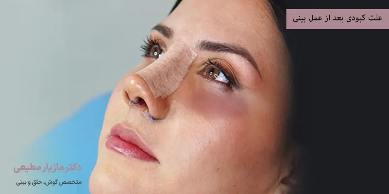 علت کبودی بعد از عمل بینی
