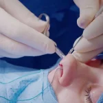 همه چیز در مورد بخیه عمل بینی