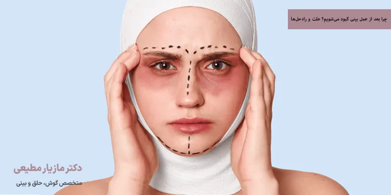 چرا بعد از عمل بینی کبود می‌شویم؟ علت و راه‌حل‌ها