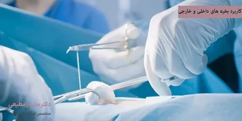 کاربرد بخیه های داخلی و خارجی