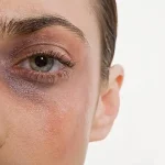 کبودی بعد از جراحی بینی