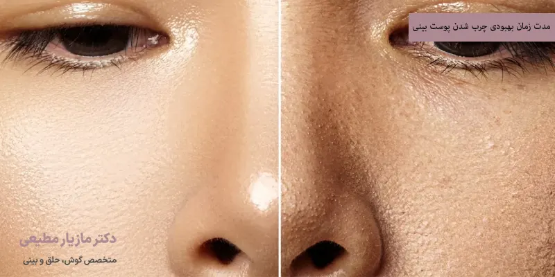 مدت زمان بهبودی چرب شدن پوست بینی