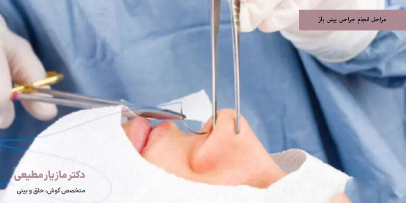 مراحل انجام جراحی بینی باز