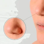 چرب شدن پوست بینی بعد از جراحی