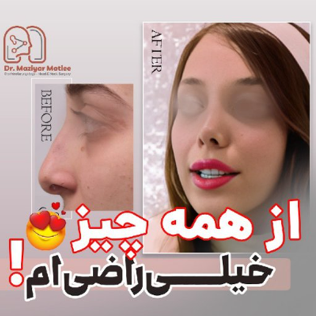 عمل بینی نیمه فانتزی قبل و بعد